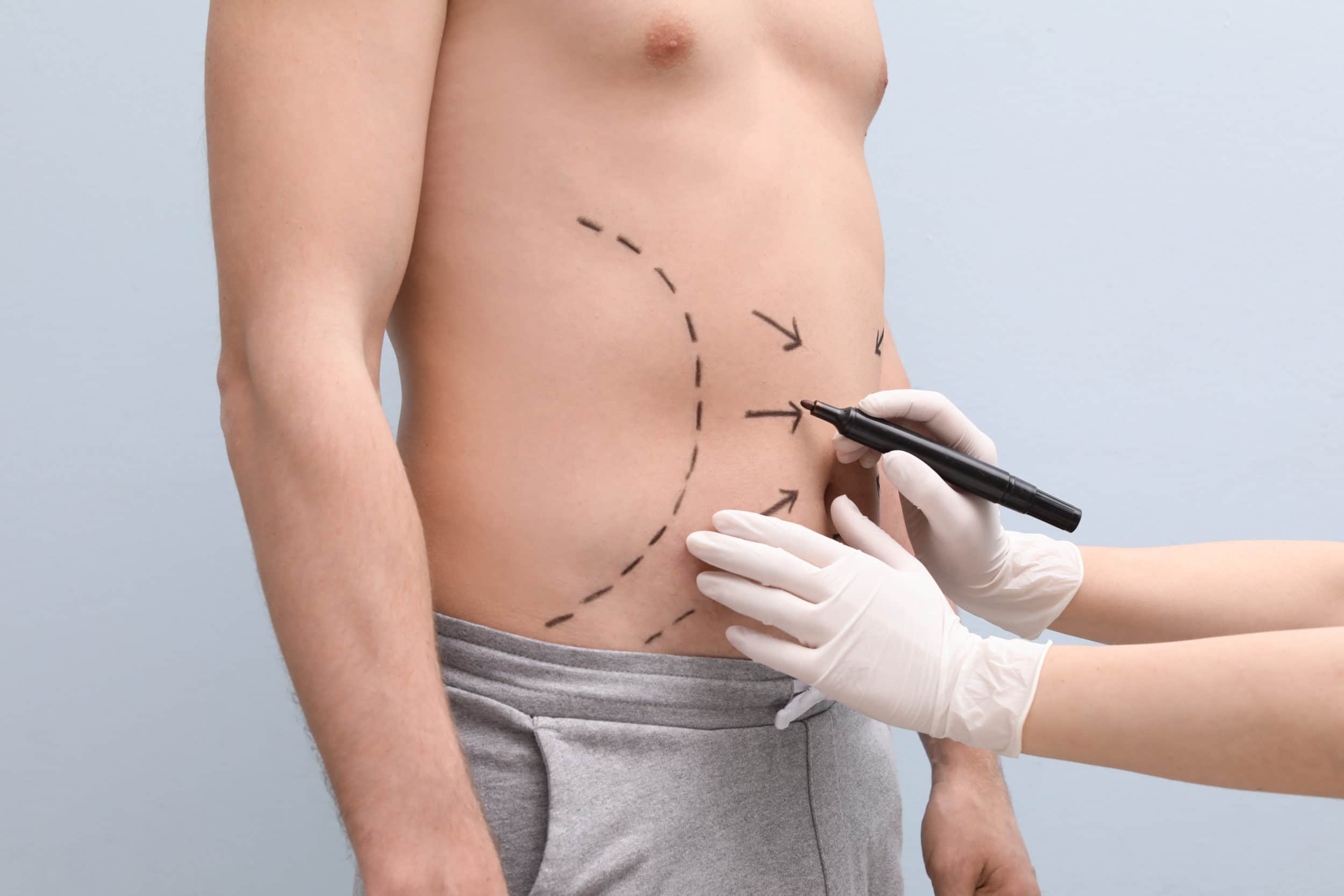 Liposuction