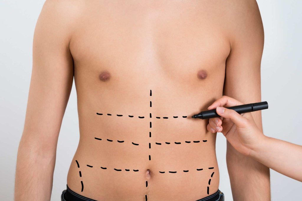 Liposuction